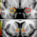 A Harvard-Northwestern study has found differences between the brains of young adult marijuana smokers and those of nonsmokers. In these composite scans, colors represent the differences — in the shape of the amygdala, top, and nucleus accumbens. Yellow indicates areas that are most different, red the least.