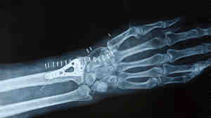 A man who breaks a wrist after age 50 is more likely to die prematurely than a woman with the same injury.