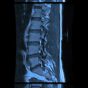 In 49 U.S. states, spotting the squished disc in this spinal MRI is still much easier than learning the price of the MRI in advance.