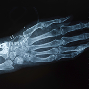 A man who breaks a wrist after age 50 is more likely to die prematurely than a woman with the same injury.