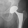 How much is that hip implant in the X-ray? Only the hospital administrator and the company that made it know for sure.