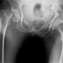 A broken hip like the one at left is a big health worry for older women.