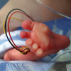 What should parents be told before their premature infants participate in a clinical study?