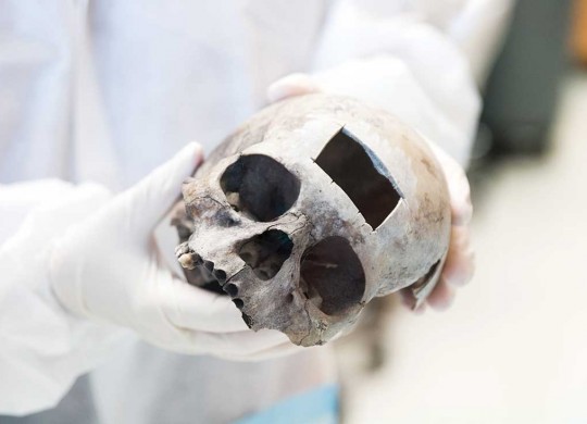 As with this skull, a small section of bone was removed from the Austin skull for DNA testing.