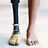 Patient with prosthetic leg (© ER Productions/Corbis)