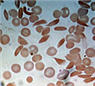 Enlarged image of red blood cells and sickle cells
