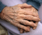 Arthritic hands