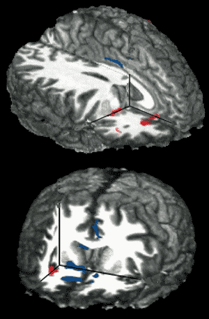COCAINE CRAVING AND HIGH CORRESPOND WITH OPPOSITE PATTERNS OF BRAIN ACTIVATION