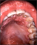 This HIV-positive patient was exhibiting signs of a secondary condyloma acuminata infection, i.e., venereal warts (This intraoral eruption of condyloma acuminata, or venereal warts was caused by the human papilloma virus).