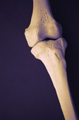 HealthDay news image for article titled: Drug Treatment for Osteoporosis Patients Urged