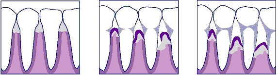 Diagram of normal gums and gums with peridontitis and advanced peridontitis