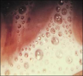 Plate 10: Profuse purulent frothy vaginal discharge. A picture of the vaginal wall heavily coated with a white mucus discharge full of small bubbles and froth attributed to infection with Trichomonas parasites.