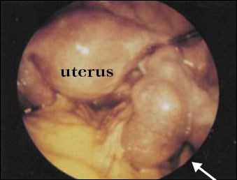 Plate 11: Picture taken inside a women's body showing the uterus and the two fallopian tubes. The right fallopian tube, which is infected with Chlamydia, is swollen to several times the diameter of the uninfected left tube and has become twisted and tortuous by comparison.
