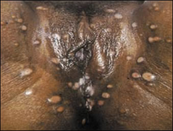 Plate 13:  Condyloma latum in secondary syphilis.  A picture of the vulva and surrounding tissues with many smooth, dome-shaped genital warts (condyloma latum) that are a symptom of secondary syphilis.