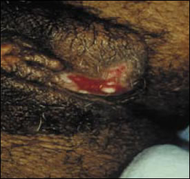 Plate 14: Lesion of herpes simplex. A picture of the lower vulva with an open, red-colored, ulcerous sore clearly visible on the lower lip of the labium majora.