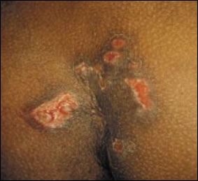 Plate 15:  Herpes simplex in woman with AIDS.  A picture of several red irregularly-shaped sores typical of Herpes simplex infection erupting from a patch of skin from a woman with AIDS (CD4 count <50/mm<sup>3</sup>).