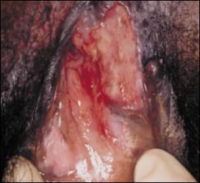 Plate 16: Apthous genital ulceration. A picture of the upper vulva (spread apart by fingers) showing a very large necrotic ulcer, typical of the more severe form of apthous ulceration. The vulval mucosa is broken over a large area with blood and other fluids oozing from the wound.