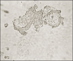 Plate 2: Clue cells of G. vaginalis vaginitis. Picture of the view through a high-power microscope of Gardnerella vaginalis cells that provide a clue to the cause of bacterial vaginosis. The G vaginalis cells look like rough-surfaced disks or globules.