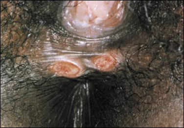Plate 6:  Nontender chancres (kissing lesions). A picture focused on the lower vulva with two chancre sores clearly visible. The sores appear as raised, round, red open wounds in the skin.