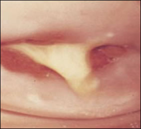 Plate 9: Mucopurulent cervicitis. A picture of the cervical orifice with some areas clearly appearing to be inflamed and swollen. A white mucus discharge also is clearly visible.