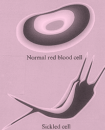 The image at the top shows a normal red blood cell (which appears oval in shape) while the image at the bottom shows a Sickled cell, which has lost its original oval shape and adopted a more flat, spiny-pointed shape.