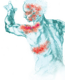 The pain and rash commonly begin in one of the areas shown here. - Click to enlarge in new window.