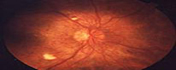 Imagen de un ojo con retinopatía diabética
