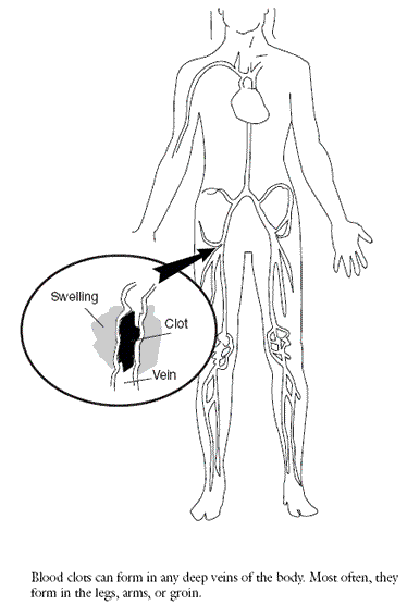 Figure 1: Illustration of a Blood Clot. For details, go to text description below.