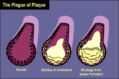 graphic showing 3 cells with different amounts of plaque