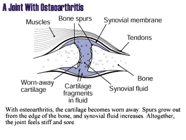 An illustration of a joint with osteoarthritis