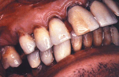 Photo of cervical caries, dark areas of decay in the area of the teeth near the gumline.