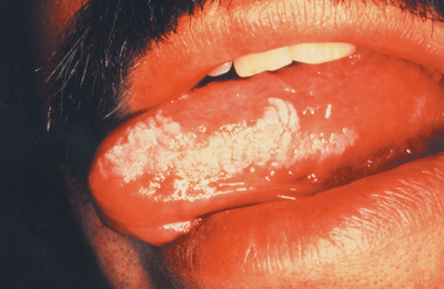 Photo of oral hairy leukoplakia: white patches on laternal border of the tongue.