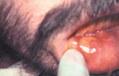 Photo of recurrent aphthous stomatitis, or canker sores: moist sore inside lower lip.