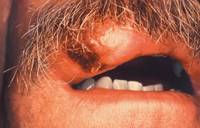 Photo of recurrent herpes simplex lesion: dark, swollen scabbed lesion on upper lip.