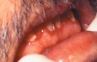 Photo of  linear gingival erythema: red margins at gumline along lower front teeth.