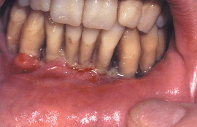 Photo of necrotizing ulcerative peridontitis: receding, dark gumline along lower front teeth.