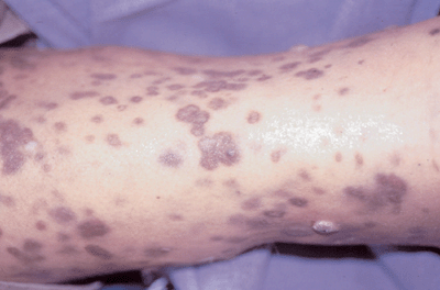 Photo of diffuse Kaposi's sarcoma: discrete purple patches on leg.