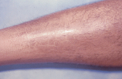 Photo of eczema craquele with icthyosis: shiny, cracked skin on calf of leg.