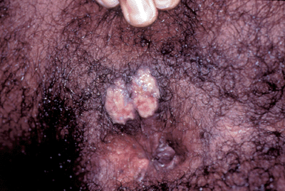 Photo of peri-anal herpes simplex virus: moist, red to white open lesions.