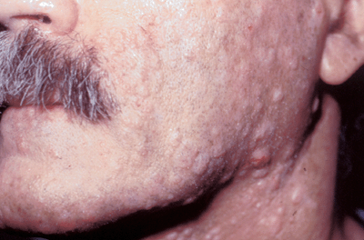 Photo of molluscum: raised, dry lesions on face.