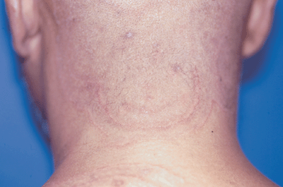 Photo of tinea corporis: red circles on back of head and neck.