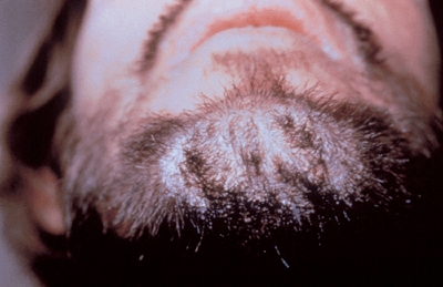 Photo of crusted scabies: light patchy areas in beard on chin.