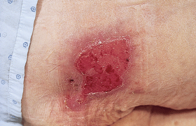 Photo of Stage II decubitus ulcer on ischeal tuberosity (buttock).
