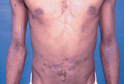 Photo of prurigo nodules: dark patches on abdomen.