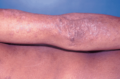Photo of atopic dermatitis: dark, dry, scaly patches on back of arm.