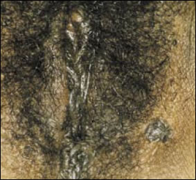 Plate 5:  Severe vulvar intraepithelial neoplasia. Picture of a vulva with severe (Stage 3)  vulvar intraepithelial neoplasia (VIN3), as evidenced by several easily noticeable areas of abnormal skin cells. The abnormal cells form bumps and wrinkles on what should be normally smooth skin.