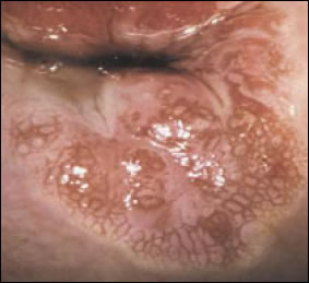 Plate 8: Cervical intraepithelial neoplasia. A picture of the cervical opening and lip with distorted areas characteristic of Stage 3 (severe) cervical intraepithelial neoplasia. The areas show both a mottled coloration (mosaicism) and swelling/bumps typical of abnormal tissue.