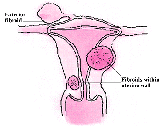 Uterine fibroids, one exterior to the uterus, and two in the uterine wall.