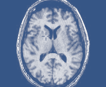 MRI brain scan