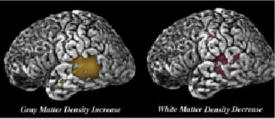 Figure 3 Changes in brain tissue density in children with heavy prenatal alcohol 